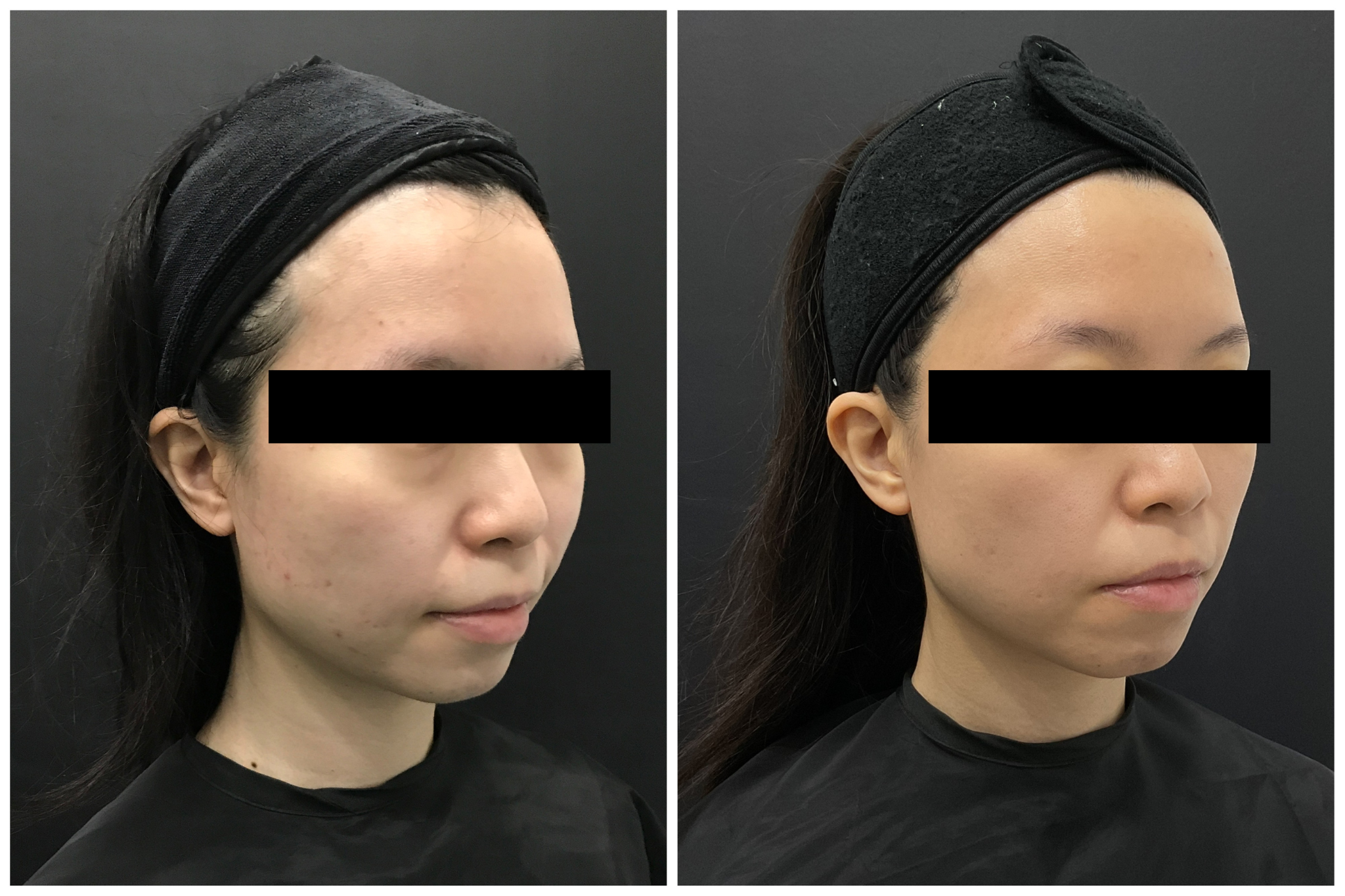 Discovery Pico Before After 1