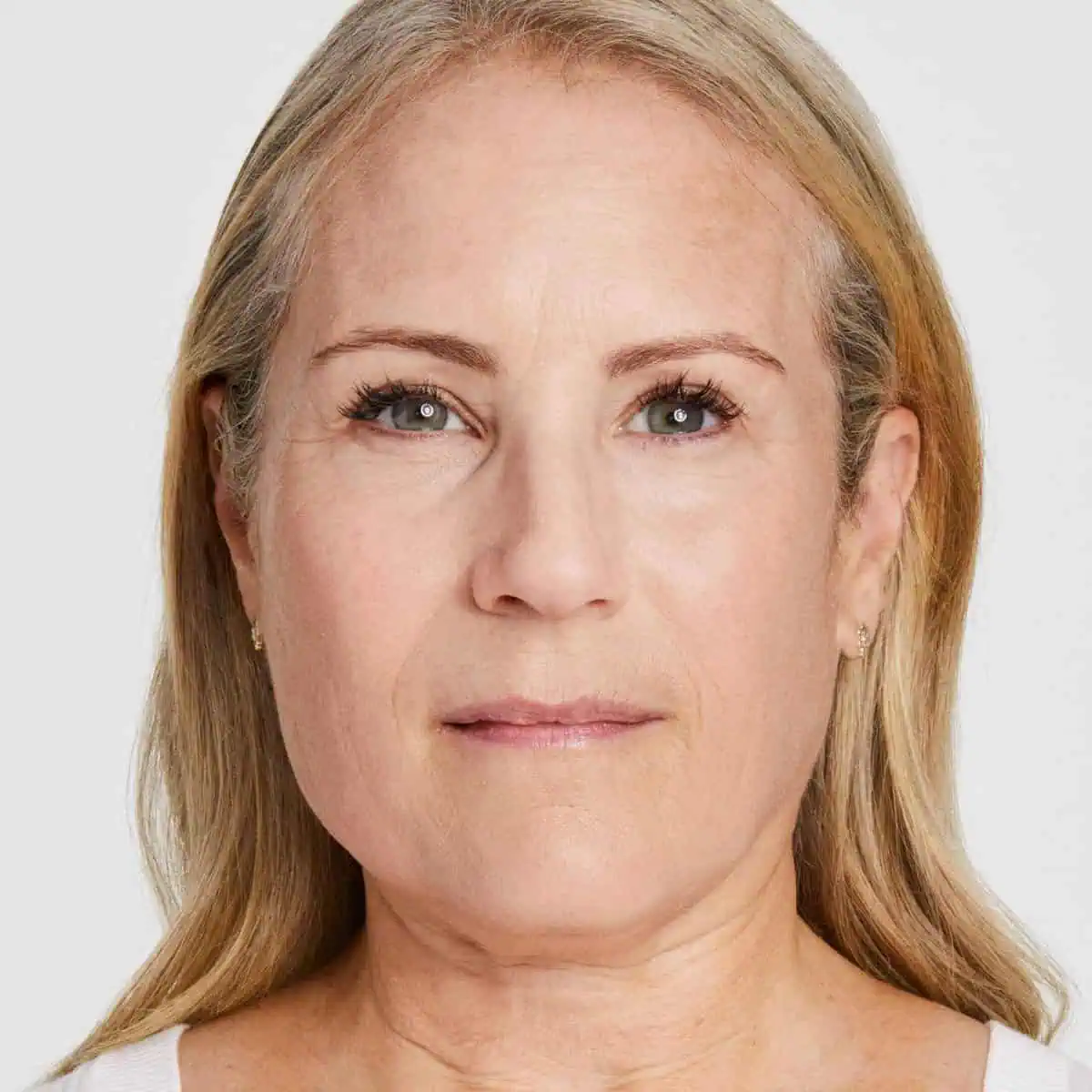 ultherapy before result